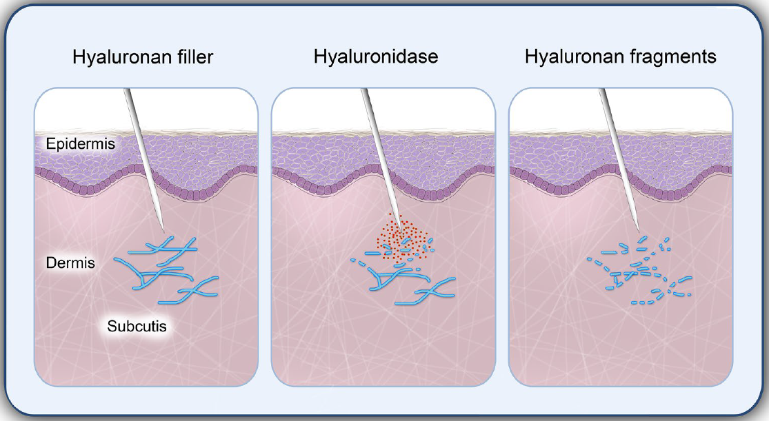Гиалуронидаза - помощник при неудачной гиперкоррекции - Christinas Clinic