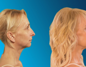 chin implant