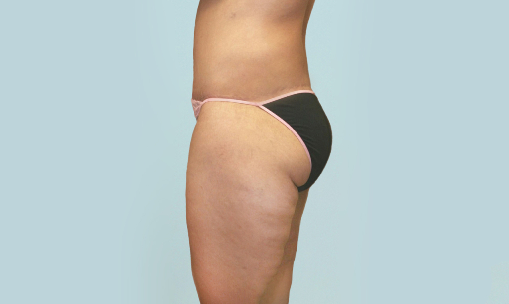 Changing body shape is possible - a 360° Body Lift surgery can