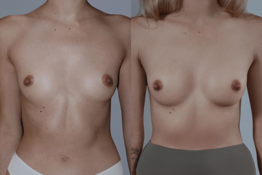 Naza topless