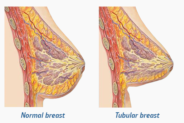 Reasons Why Women May Have Breasts Far Apart and How to Treat Them 