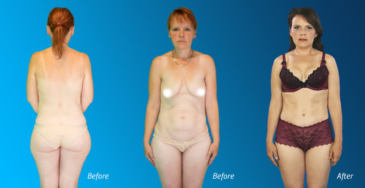 mommy makeover, mommy makeover, 360 degree liposuction, liposuction, rasvaimu, rasvasiirdamine rindadesse, lipofilling breasts, emade imeline muutumine, emade pakett, esteetiline kirurgia, ilukliinik, Christinas Clinic, tv3, Duubel, minu imeline muutumine, iluoperatsioon, ilukirurgia, iluoperatsioonid, rindade tõstmine, kõhuplastika, diastaas, lõuaimplantaat, lõua endoproteesimine, lõua korrigeerimine implantaadiga, rasvasiirdamine näopiirkonda, silmalaugude plastika, ilusüstid, täiteüstid, huulte suurendamine, huulte korrigeerimine, botox, botoks, botuliintoksiini süstid, täiteüstid, miimikakortsud, Mommy makeover Tallinn, ilukirurgia Tallinnas, plastikakirurg, plastiline kirurgia, ilukirurg, äitien ihmemuutos, äitipaketti, esteettinen kirurgia, kauneusklinikka, Christinas-klinikka, tv3, Tupla, ihmeellinen muutokseni, kauneuskirurgia, kosmeettinen kirurgia, kauneuskirurgiat, rintojen lisäys, vatsakirurgia, diastaasi, leukaimplantti, leuan endoproteesit, leuan korjaus , silmäluomen muovit, kauneusinjektiot, täyteaineet, huulten lisäys, huulten korjaus, botox, botox, botuliinitoksiininjektiot, täyteaineet, matkimat ryppyjä, Äiti-muunnos Tallinna, kosmeettinen kirurgia Tallinnassa, plastiikkakirurgi, plastiikkakirurgia, kosmeettinen kirurgi, чудесное изменение матери, пакет для матерей, эстетическая хирургия, клиника красоты, клиника Кристинас, tv3, Double, мои чудесные изменения, косметическая хирургия, косметическая хирургия, косметические операции, увеличение груди, абдоминальная хирургия, диастаза, имплантация челюсти, эндопротезирование челюсти, восстановление челюсти , пластика век, косметические инъекции, пломбирование, увеличение губ, коррекция губ, ботокс, ботокс, инъекции ботулинического токсина, пломбирование, мимические морщины, макияж мамы Таллинн, косметическая хирургия в Таллине, пластический хирург, пластическая хирургия, косметический хирург,