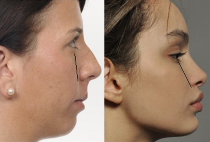 Нос с горбинкой – как исправить?